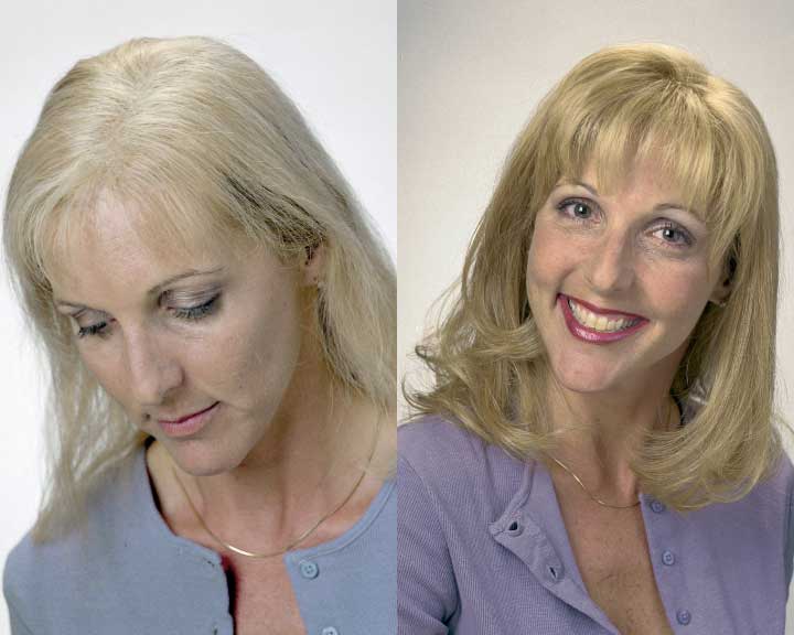   donna's dramatic hair loss transformation  