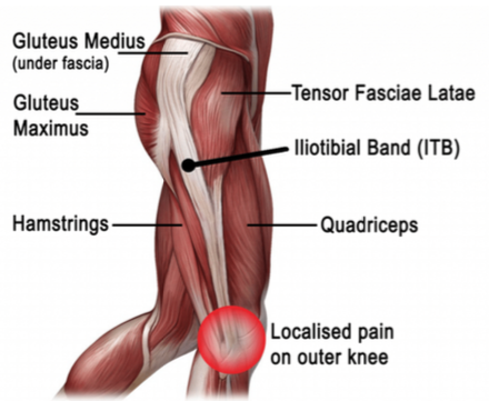 iliotibial band syndrome causes