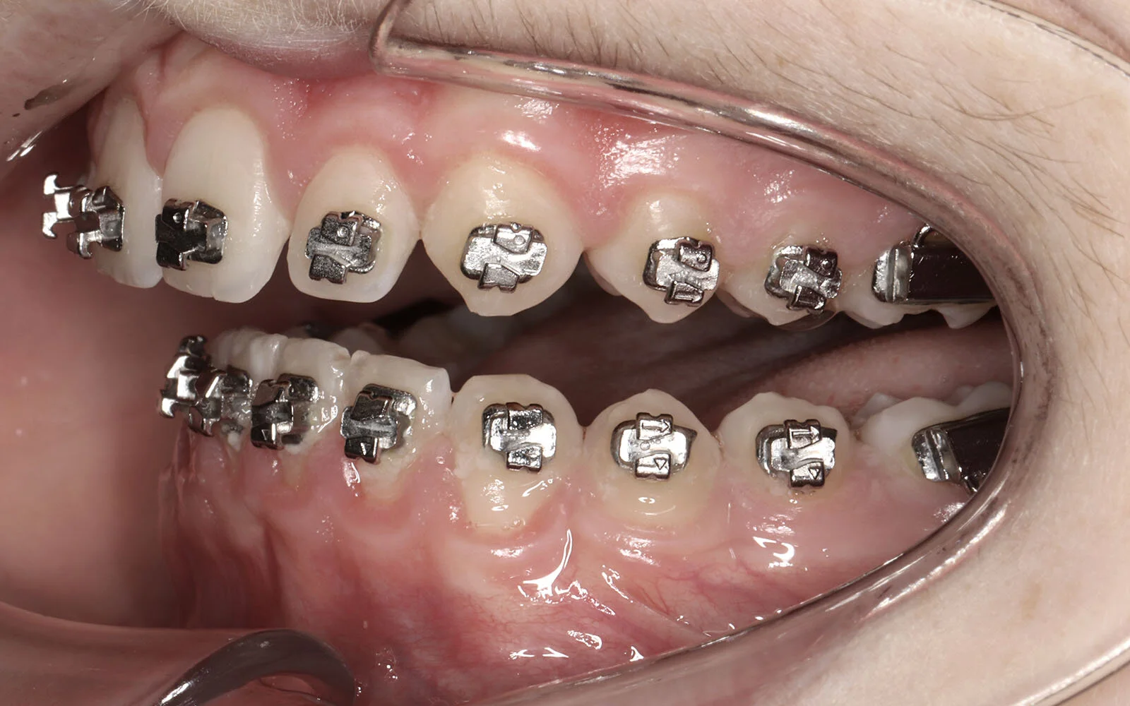 Brackets and molar tubes.