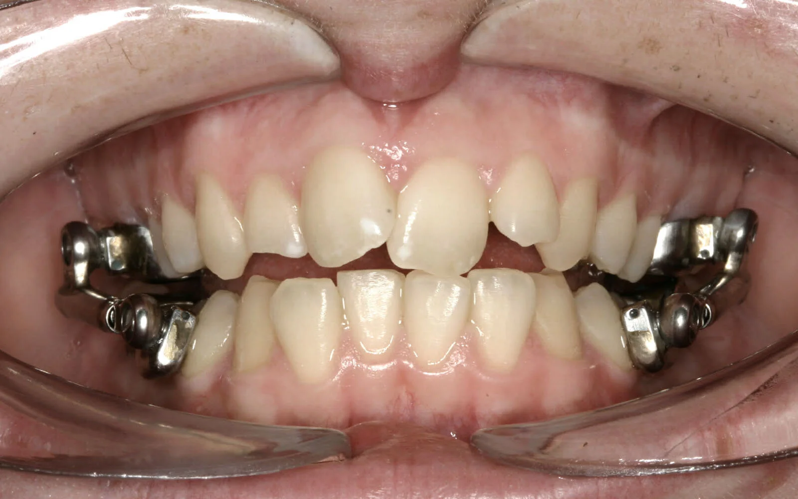 _0003_bitecorrectionplate2.jpg