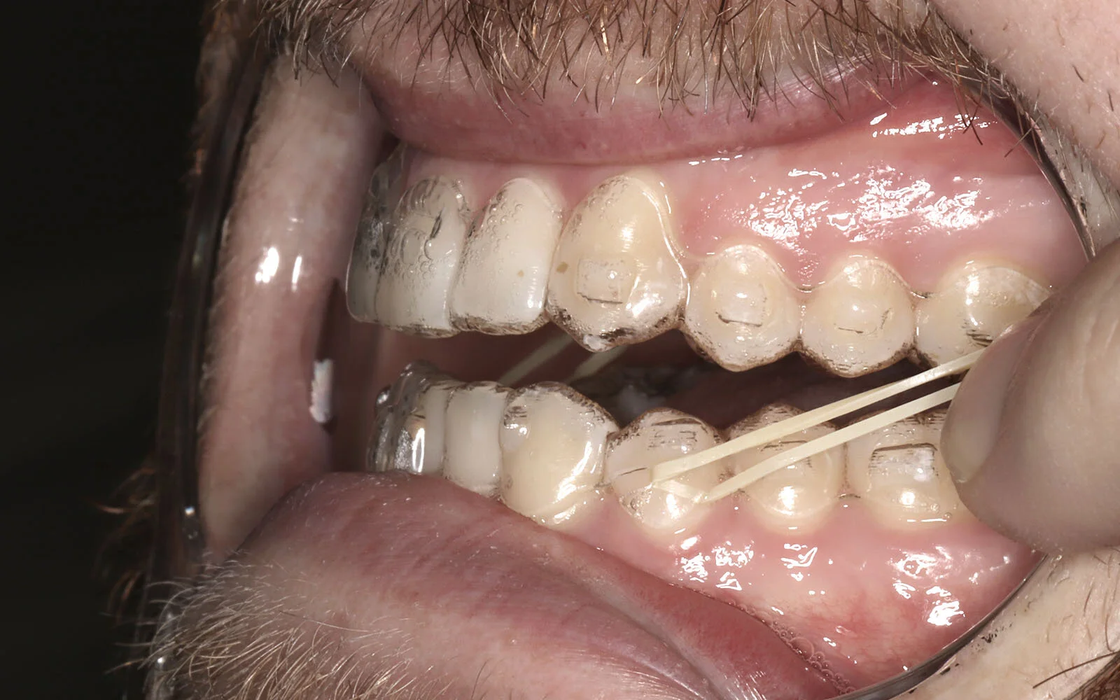_0008_clearaligners.jpg