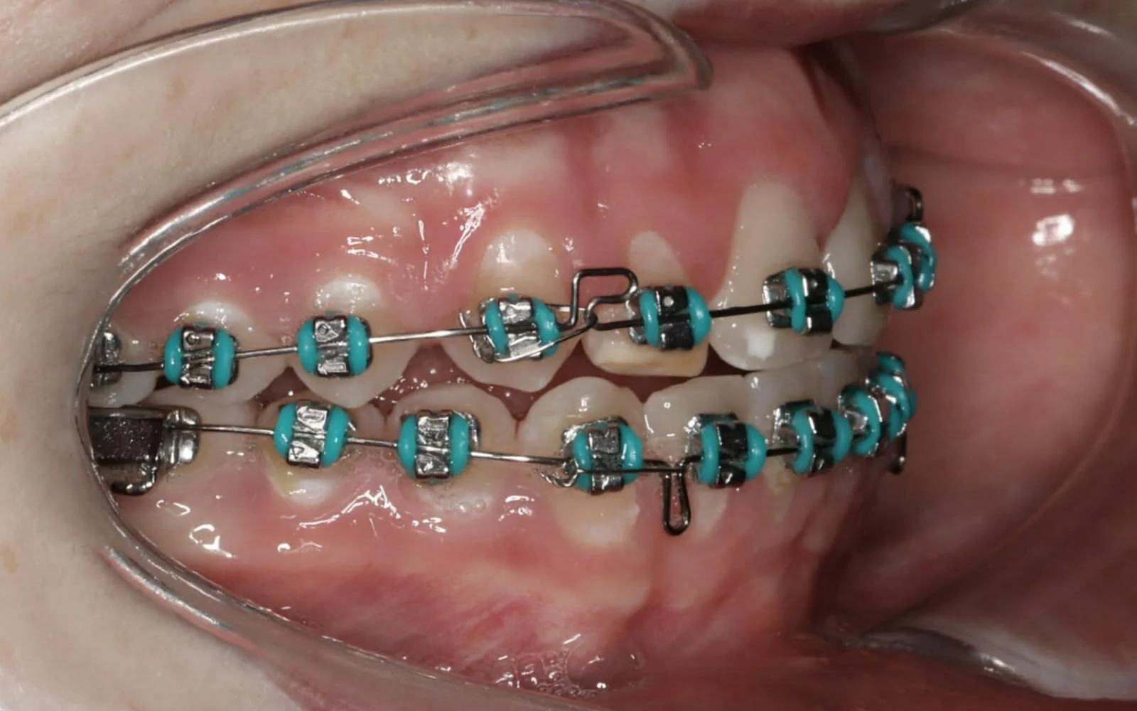 elastics-closed.jpg