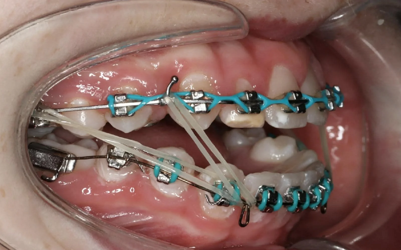 elastics-open2.jpg