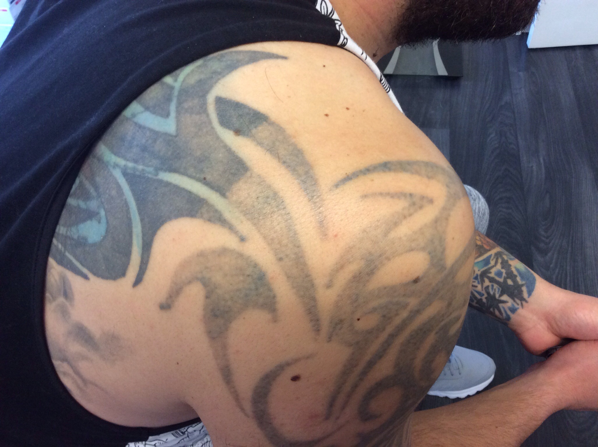 Update more than 164 fade tattoo removal latest