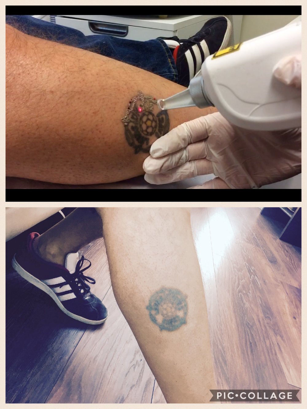 Pictures of tattoo removal today - Maria Patricia - Laser Tattoo Removal -  Laser Hair Removal - Carbon Laser - Skin Rejuvenation - Dermal Rollers