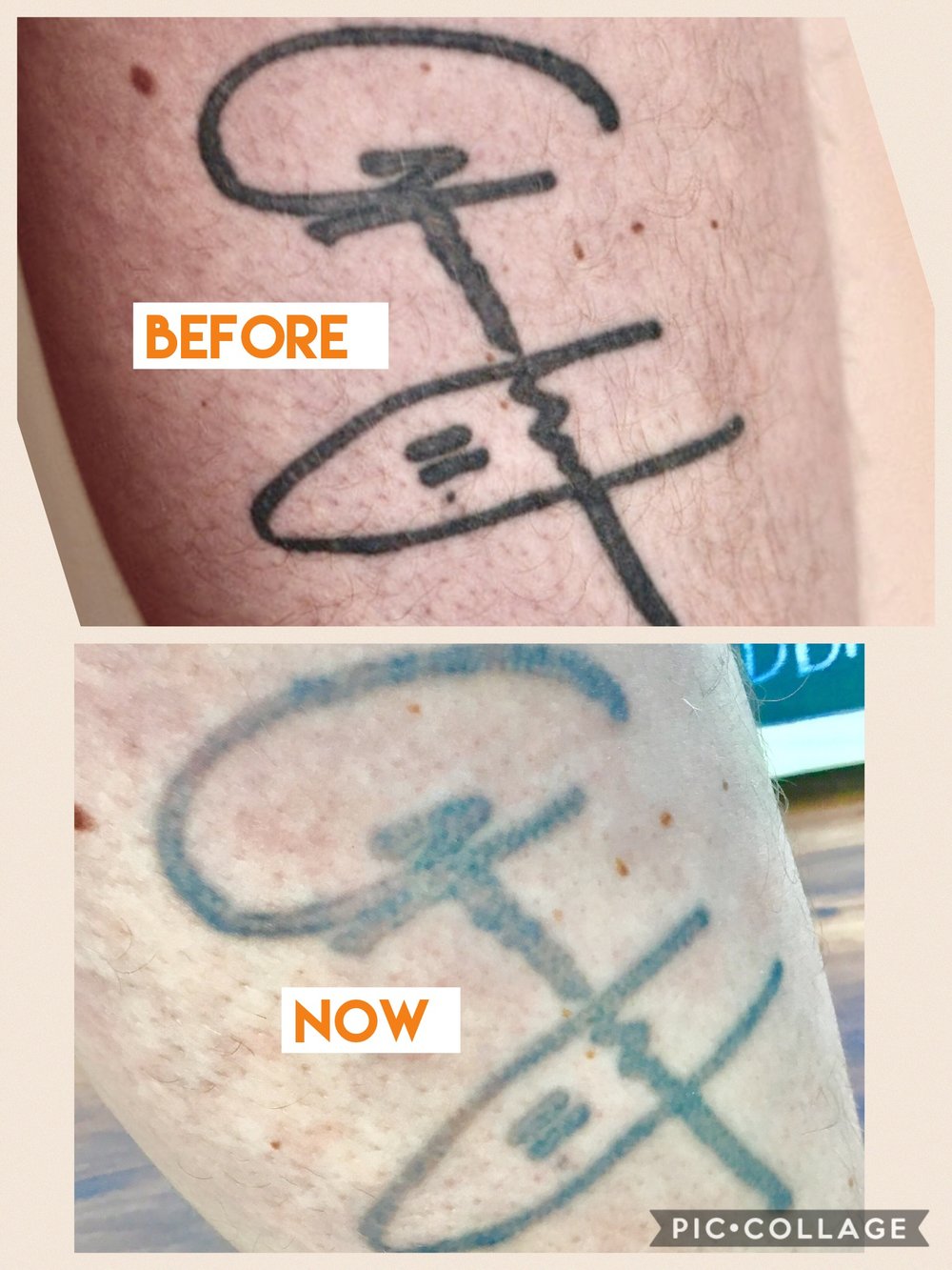 Tattoo fading - Maria Patricia - Laser Tattoo Removal - Laser Hair Removal  - Carbon Laser - Skin Rejuvenation - Dermal Rollers