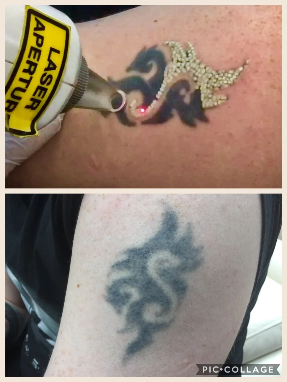 Small dark tribal tattoo removal - Maria Patricia - Laser Tattoo Removal - Laser  Hair Removal - Carbon Laser - Skin Rejuvenation - Dermal Rollers