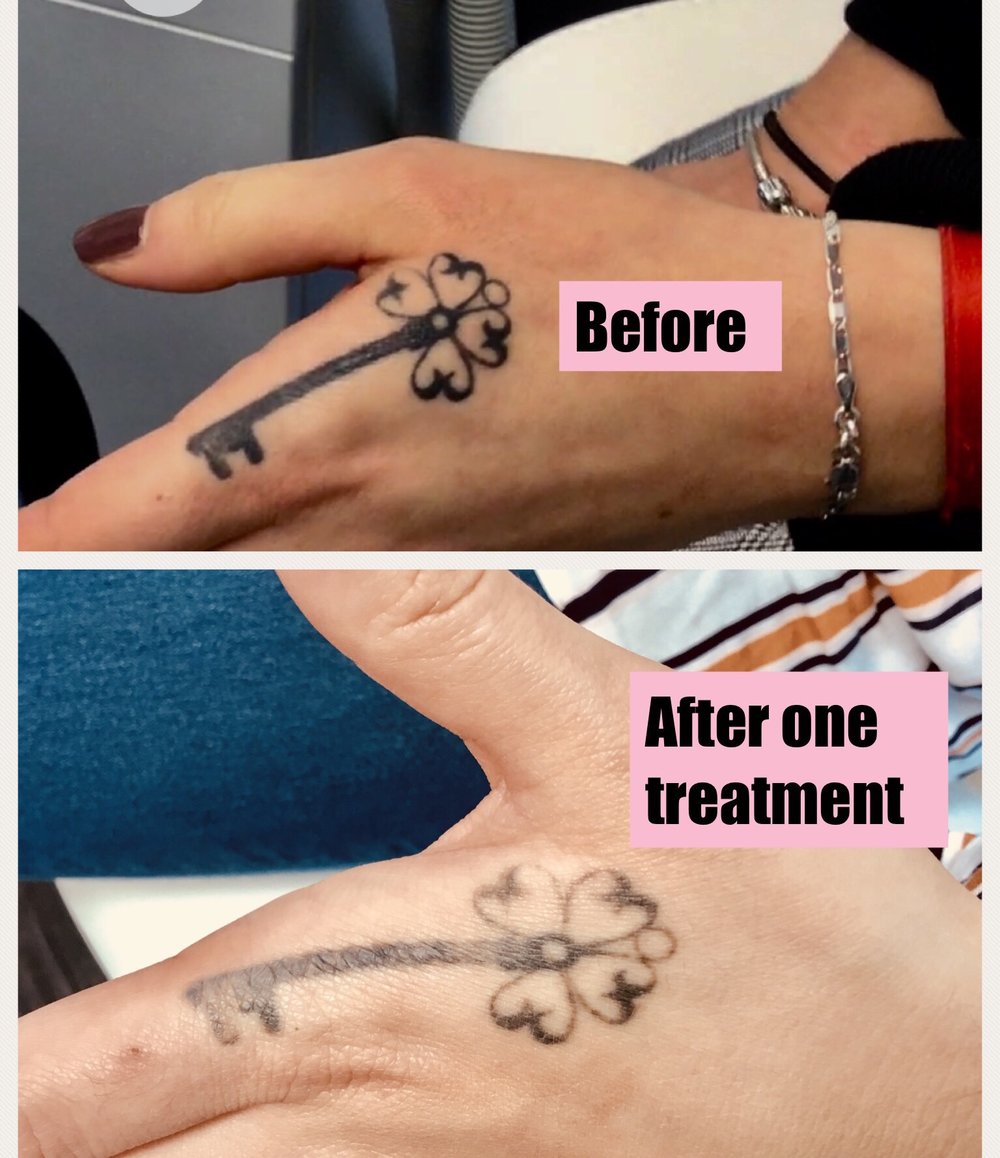 Fading after only one treatment - Maria Patricia - Laser Tattoo Removal -  Laser Hair Removal - Carbon Laser - Skin Rejuvenation - Dermal Rollers