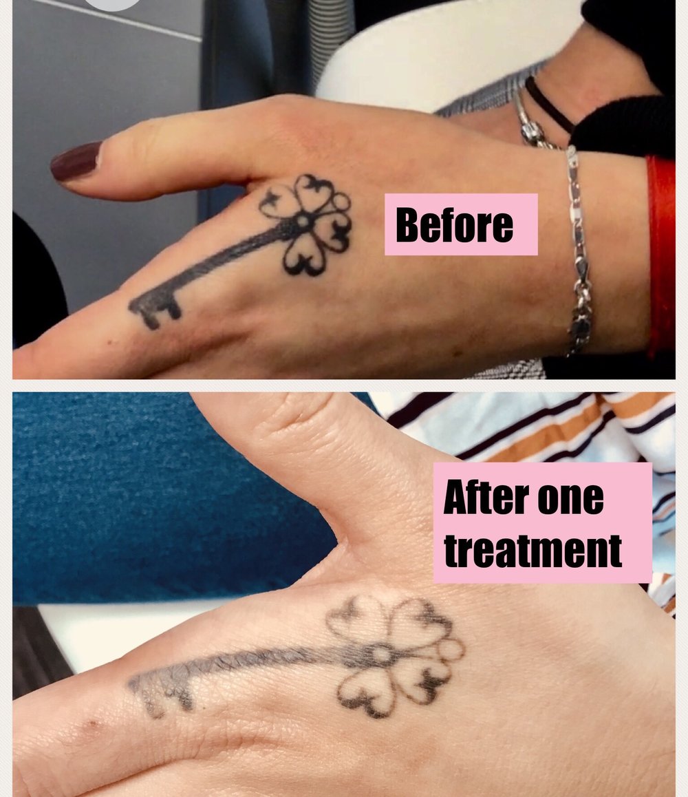 Fading after only one treatment - Maria Patricia - Laser Tattoo Removal - Laser Hair Removal - Carbon Laser - Skin Rejuvenation - Dermal Rollers Fading after only one treatment - Maria Patricia - Laser Tattoo Removal - Laser Hair Removal - Carbon Laser - Skin Rejuvenation - Dermal Rollers
