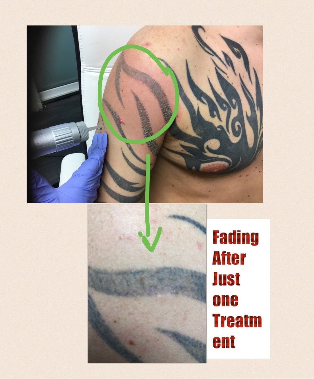 Tribal fade after one treatment - Maria Patricia - Laser Tattoo Removal -  Laser Hair Removal - Carbon Laser - Skin Rejuvenation - Dermal Rollers