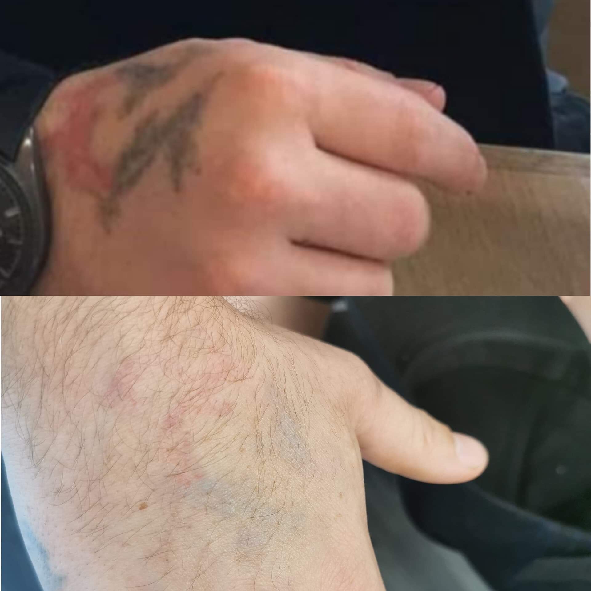 Arms  Hands Laser Tattoo Removal Before  After Results