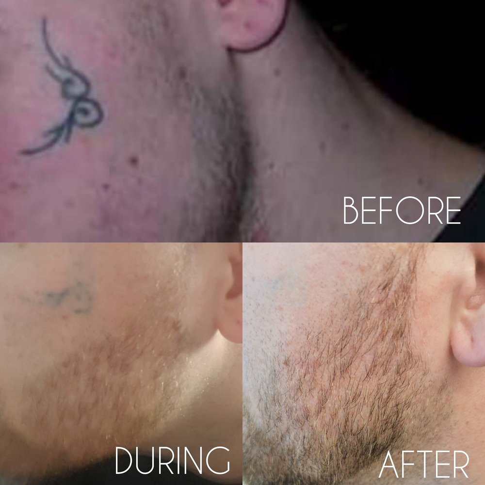 Before, during & after - tattoo removal - Maria Patricia - Laser Tattoo  Removal - Laser Hair Removal - Carbon Laser - Skin Rejuvenation - Dermal  Rollers