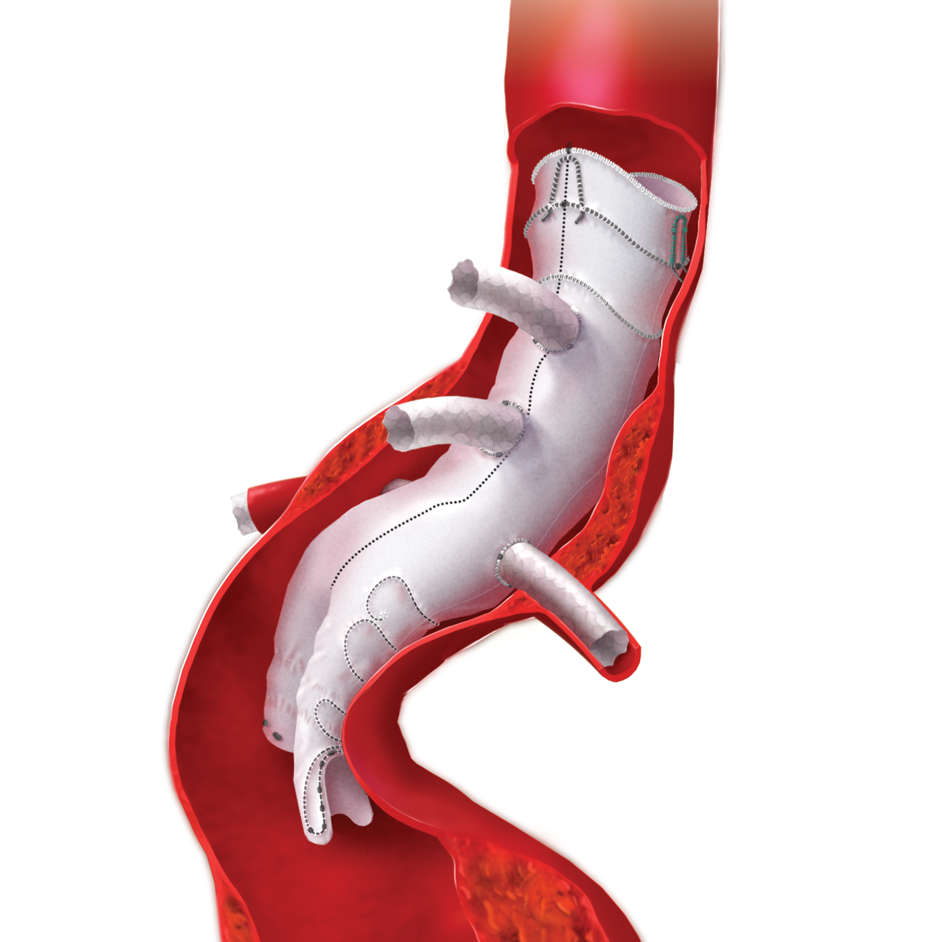 annie_camobell_medical_illustration_aneurysm_02.png