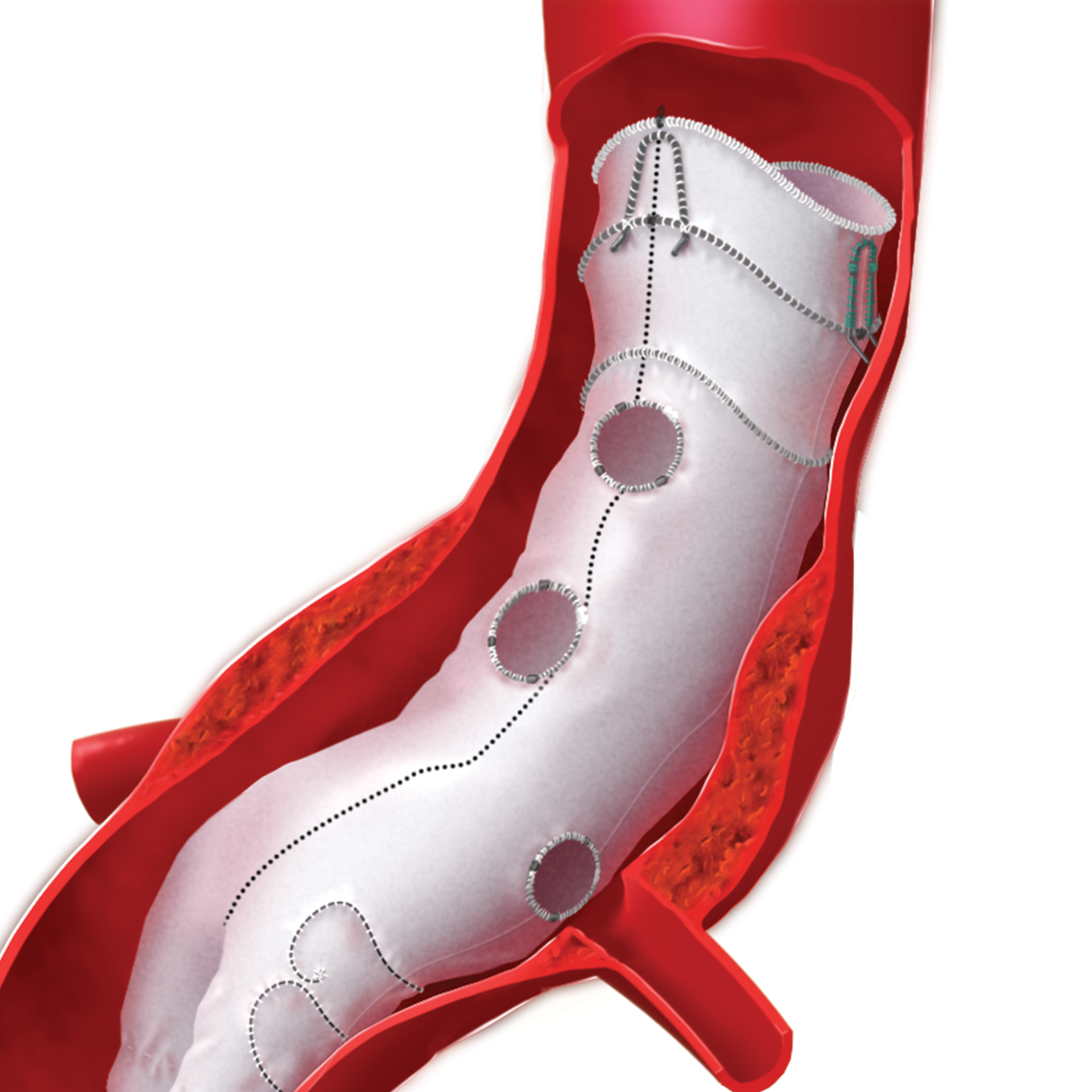 annie_camobell_medical_illustration_aneurysm_04.png