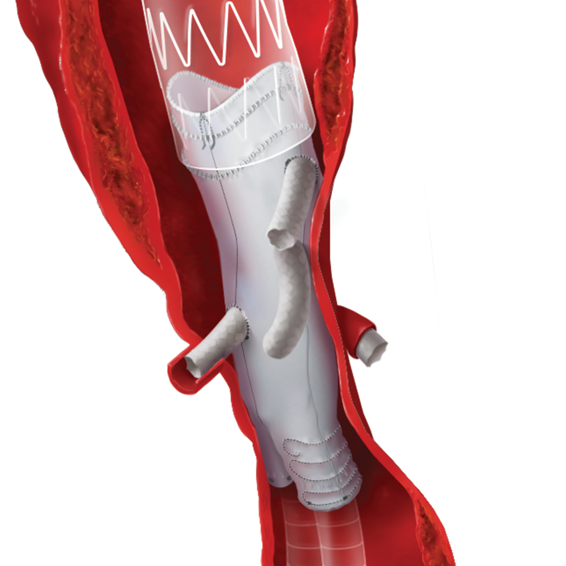 annie_camobell_medical_illustration_aneurysm_06.png