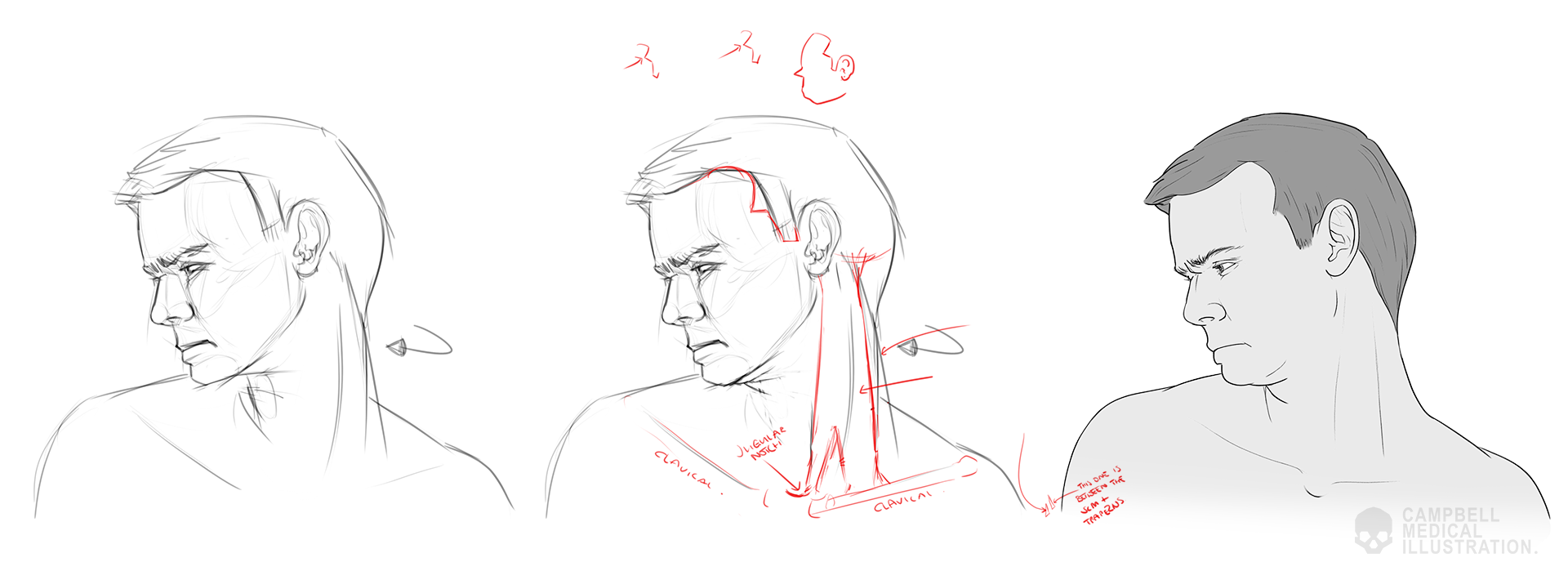 Susanna-Brighouse-Acute_Dystonia-medical-illustration-work-in-progress.png