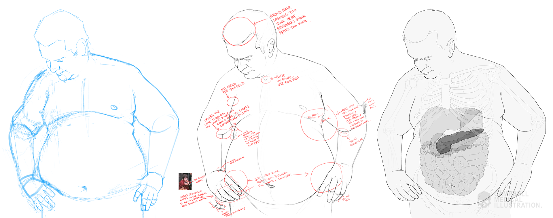 Susanna-Brighouse-obese-male-medical-illustration-work-in-progress.png