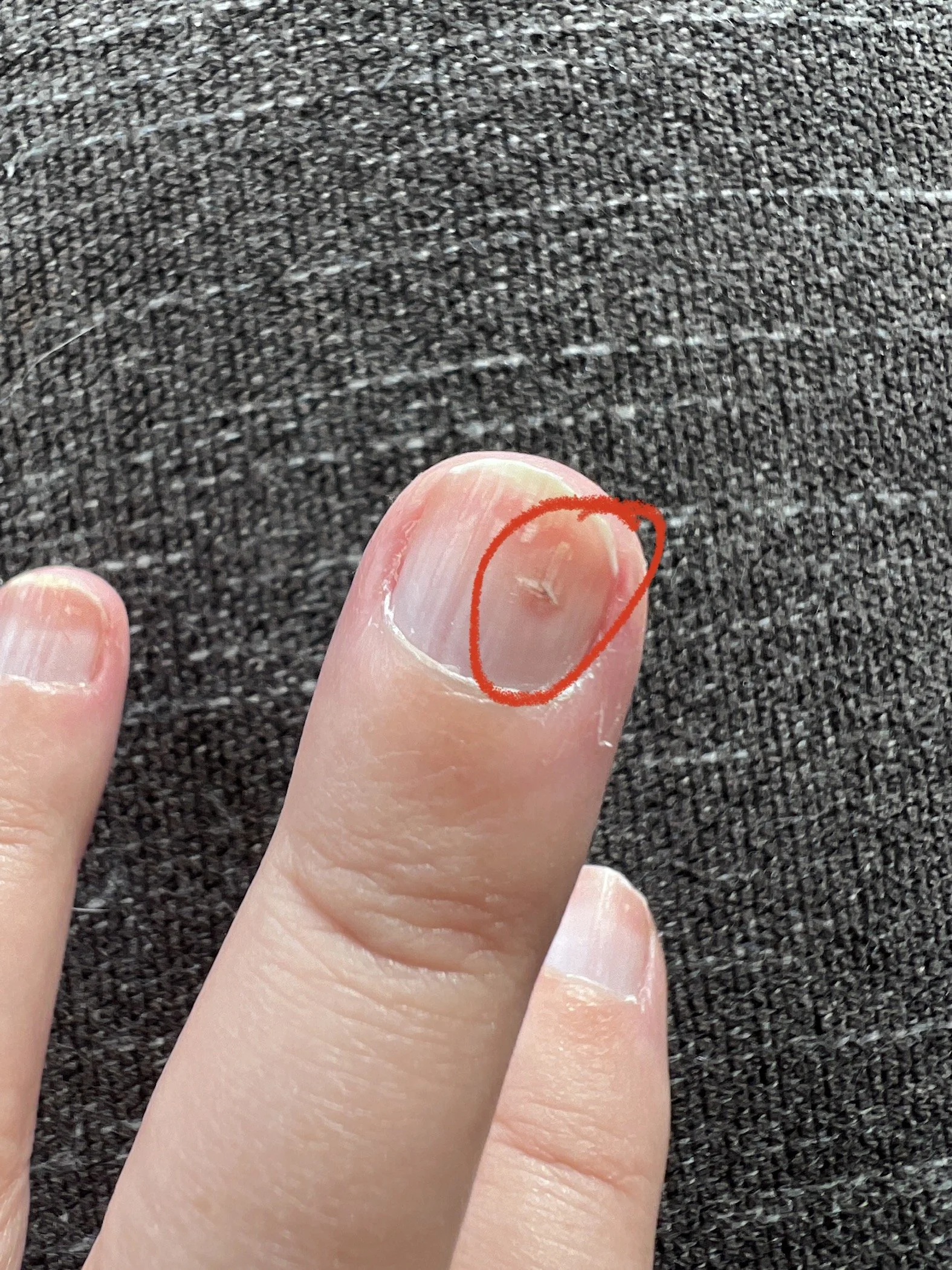 Less bloody aftermath of sewing through my finger