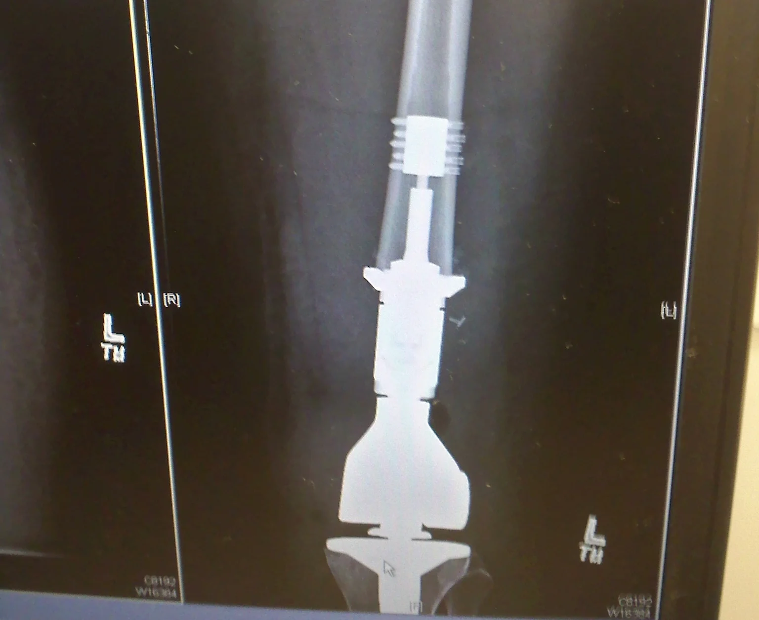Xray of Raeanna's Prosthetic Knee