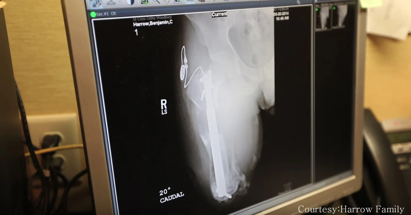 This is an X-Ray of the osteodistraction hardware in Ben's femur. During the interview he explains in full-depth how it works and where the power of perspective came in.