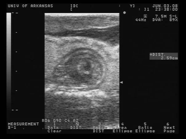 Ultrasound image of an embryonic Boa constrictor , about halfway through pregnancy. The visible coils are the embryo's skeleton, while the white material surrounding the baby is yolk.