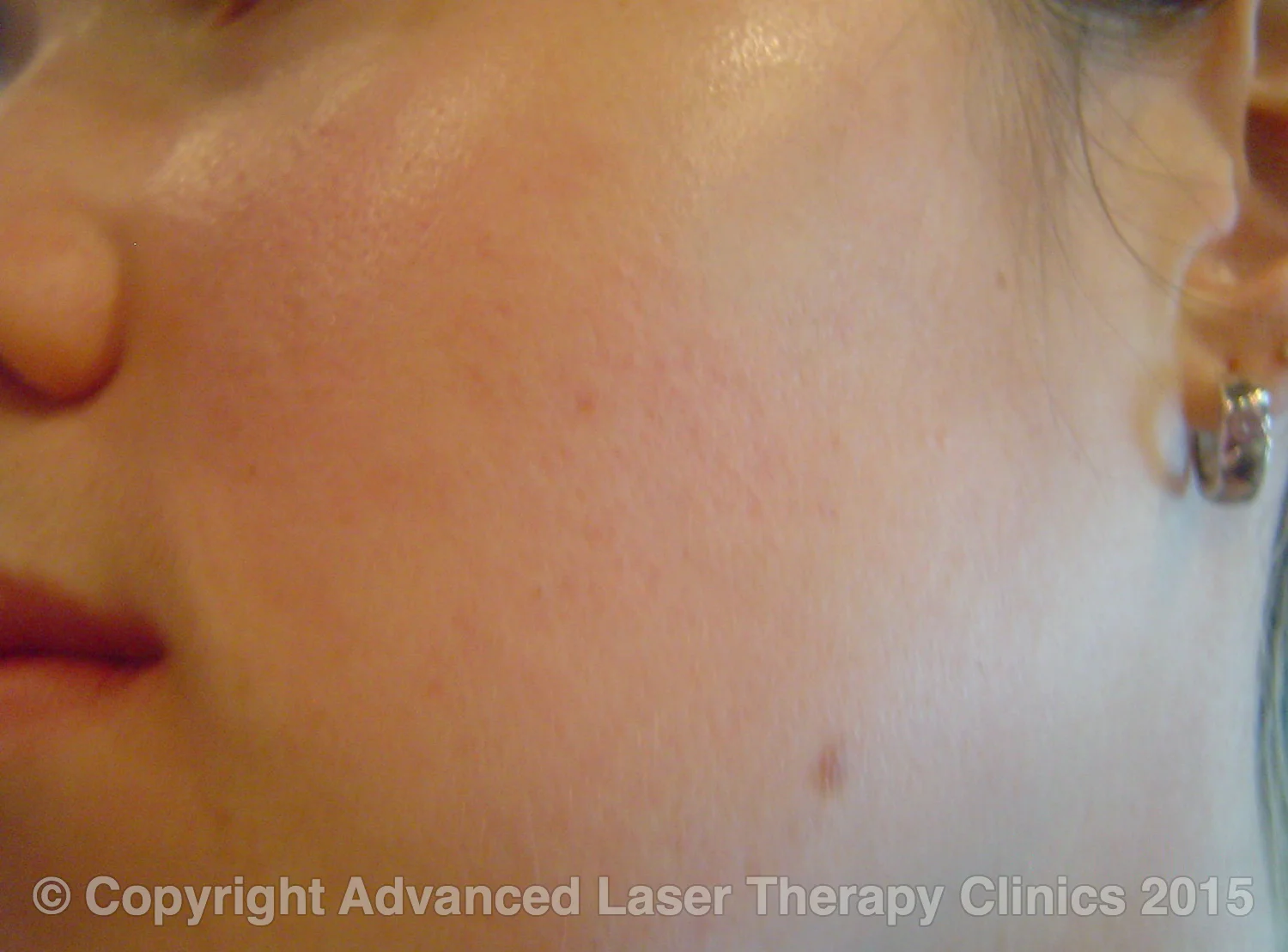 Original Herbal Peel Advanced Laser Clinic Cairns