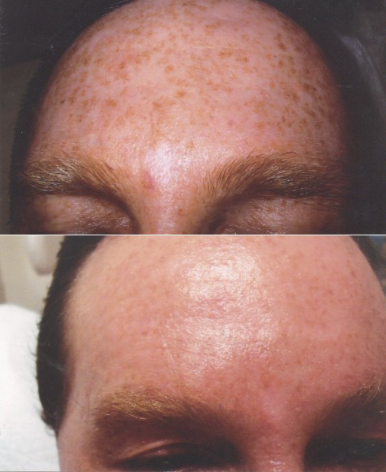 freckles-before-after.JPG
