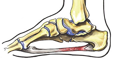 Symptoms include heel pain, especially in the first steps after getting out of bed, and stiffness/pain in the mid foot.