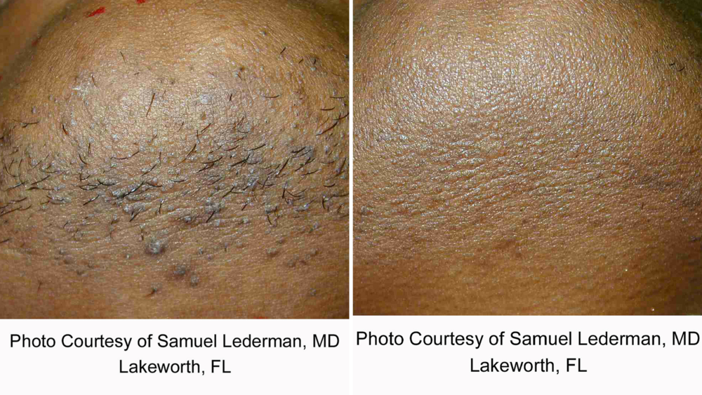 CoolGlide Laser Hair Removal — Lakes Dermatology