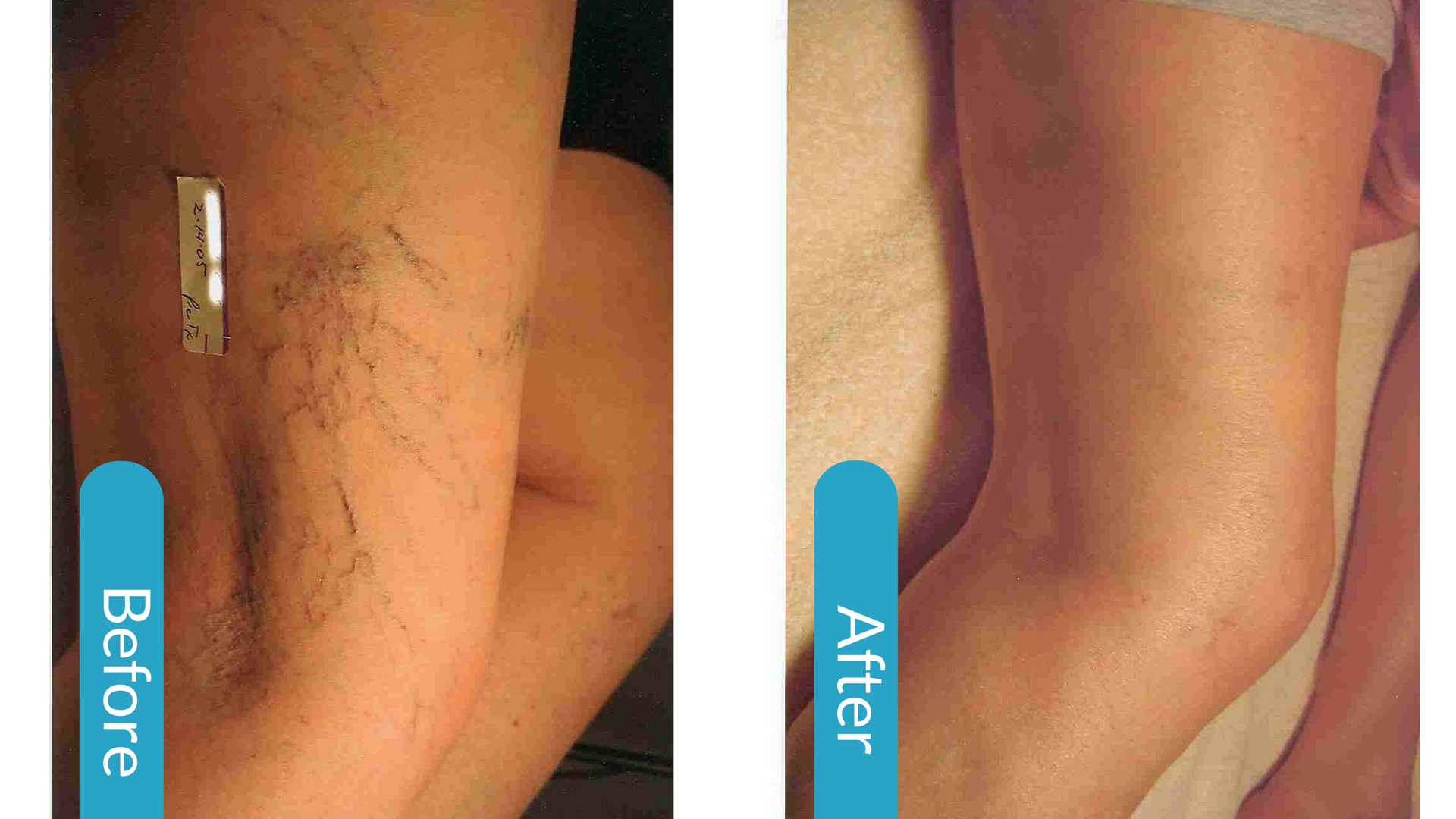 Effective Laser Treatments for Spider and Varicose Veins