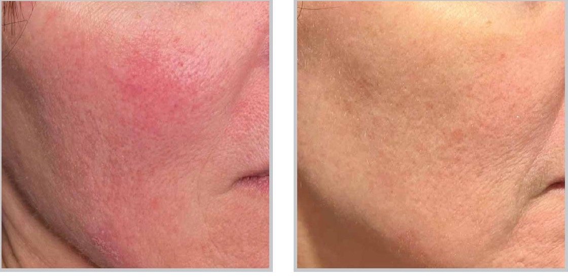 Side-by-side ClearSilk photographs before treatment and two months after two treatments