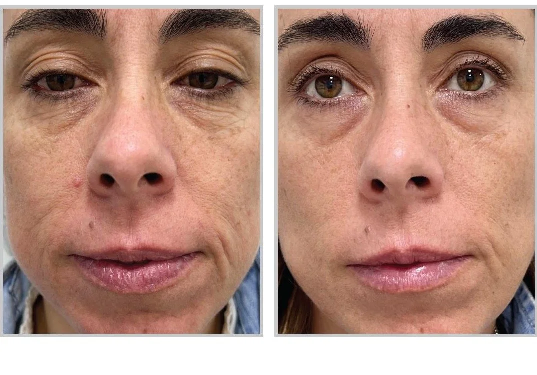 Side-by-side ClearSilk photographs before treatment and three months after three treatments
