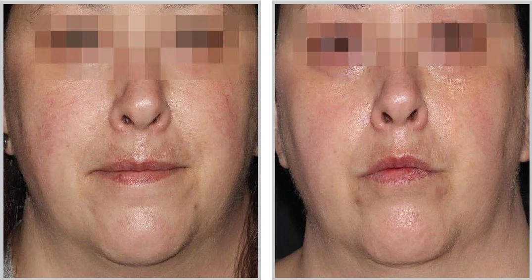 Side-by-side ClearSilk photographs before treatment and four weeks after four treatments