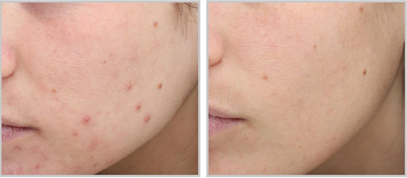 Side-by-side ClearSilk photographs before treatment and six months after three treatments