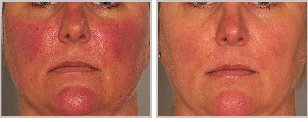 Side-by-side ClearSilk photographs before treatment and one month after four treatments