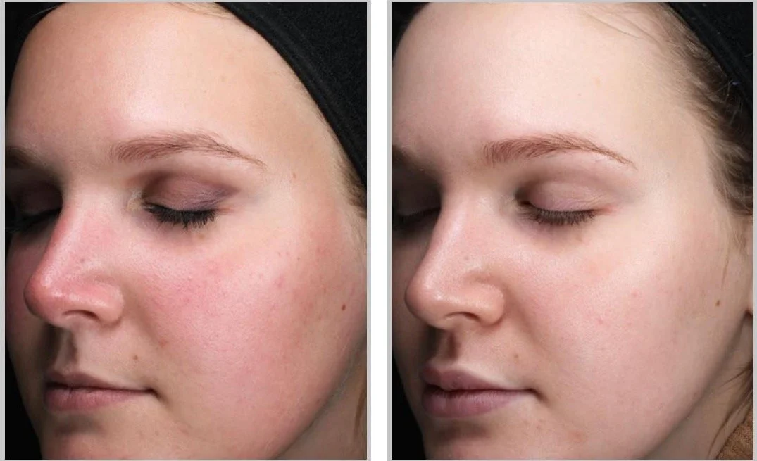Side-by-side ClearSilk photographs before treatment and six months after three treatments
