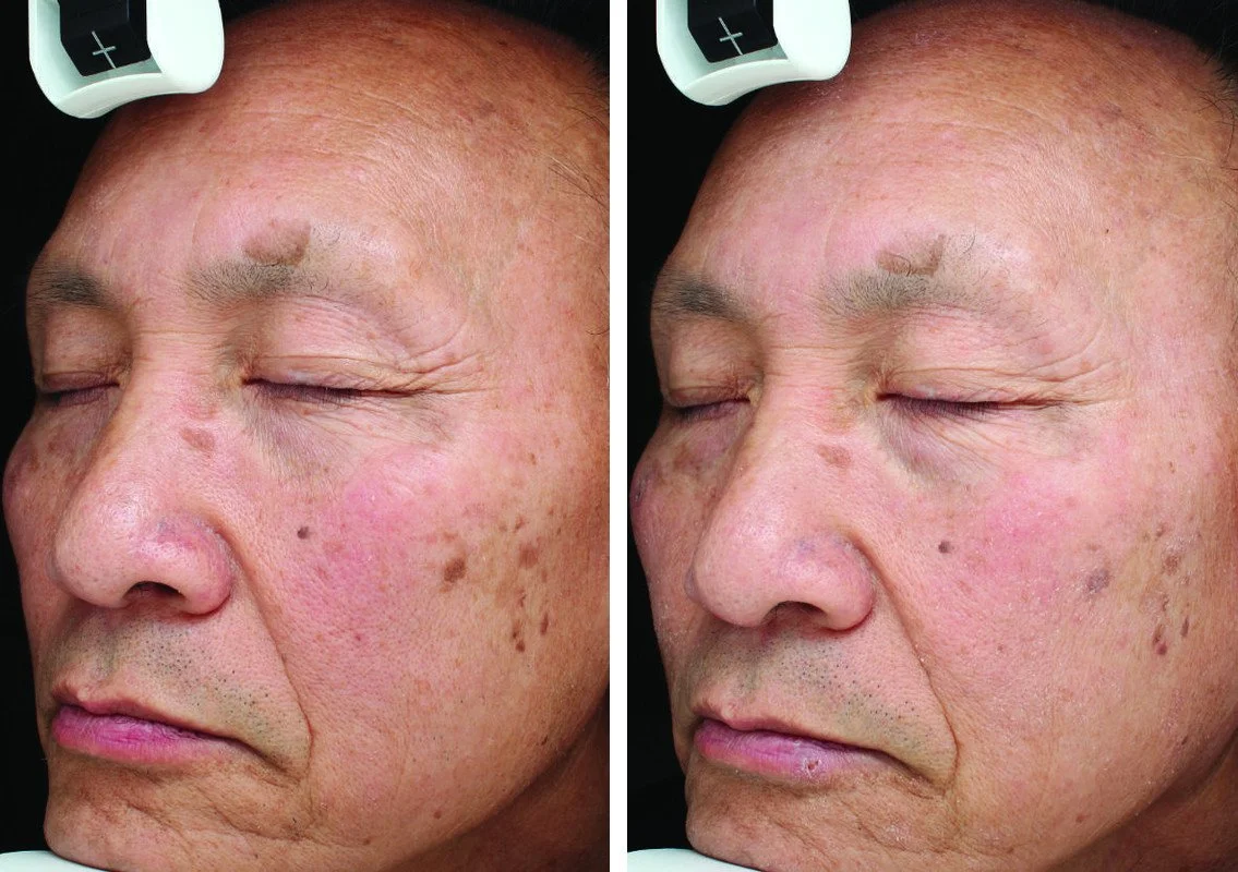 Side-by-side ClearSilk photographs before treatment and after four treatments