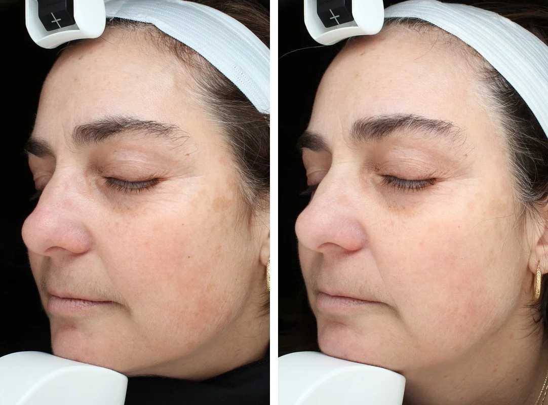 Side-by-side ClearSilk photographs before treatment and after four treatments