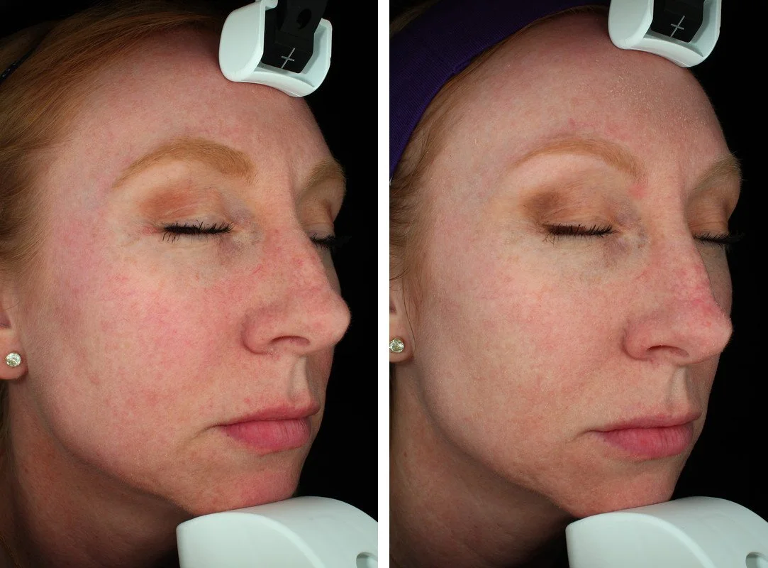 Side-by-side ClearSilk photographs before treatment and three weeks after seven treatments