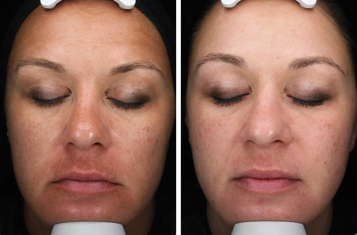 Side-by-side ClearSilk photographs before treatment and five months after four treatments
