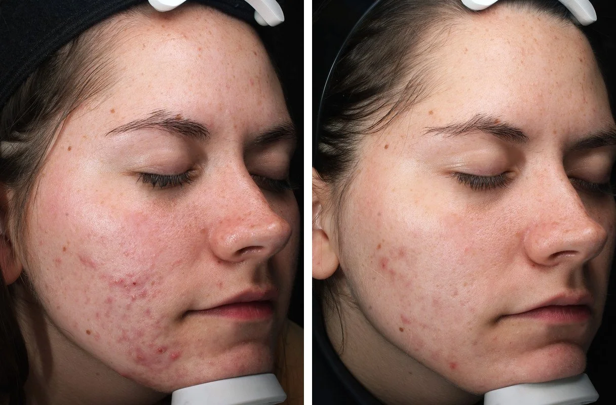 Side-by-side ClearSilk photographs before treatment and four months after three treatments