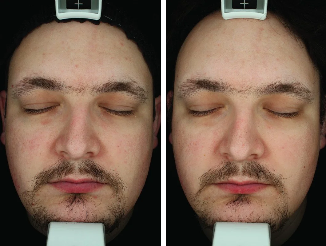 Side-by-side ClearSilk photographs before treatment and three weeks after four treatments