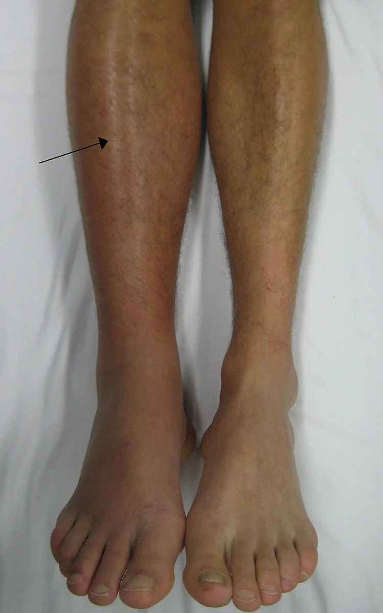 A photo of a DVT patient with a swollen left calf (via Wikimedia).