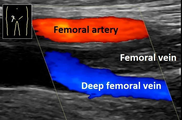 An ultrasound echo imaging will be used to show the location of the DVT located deep in your body.