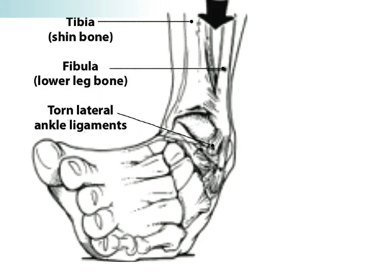 Ankle Sprains and Physical Therapy Interventions — Mend