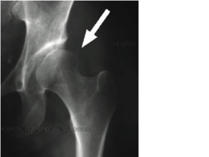 Hip Pain associated with Femoral Acetabular Impingement and Labral