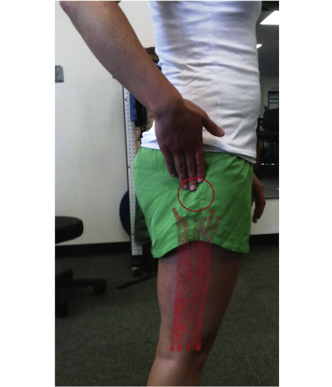 Dry Needling versus Steroid Injection for Hip Pain — Mend