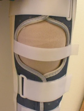 No Benefit Of Post Operative Bracing After Acl Surgery Mend