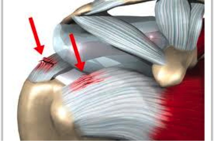 Relationship Of Age And Rotator Cuff Repair Failure — Mend