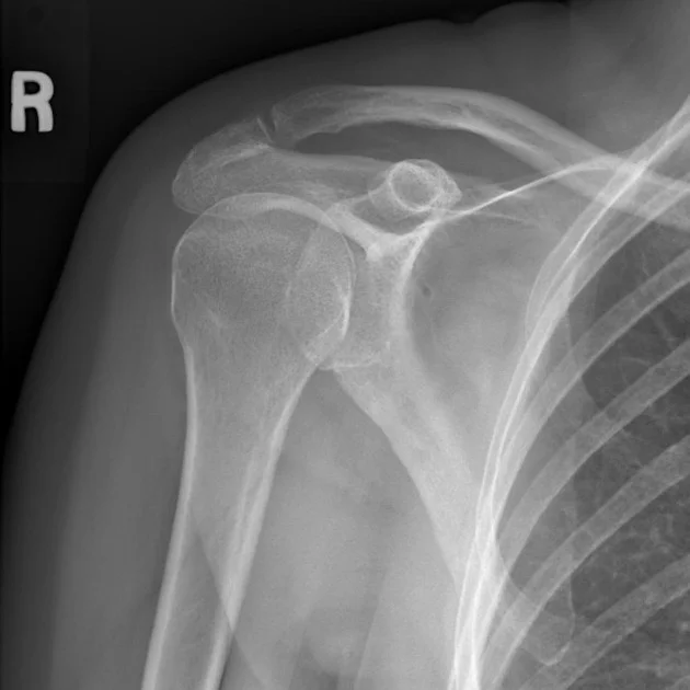 Will The Bone Spur In My Shoulder Cause A Future Rotator Cuff Tear? — Mend